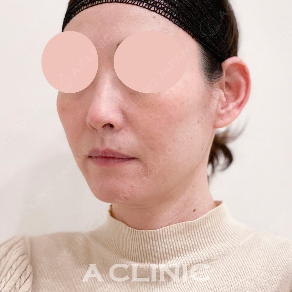 小顔になって若々しい輪郭になりましたね！Aスレッドの処置前と処置直後の症例です(40代女性) BEFORE