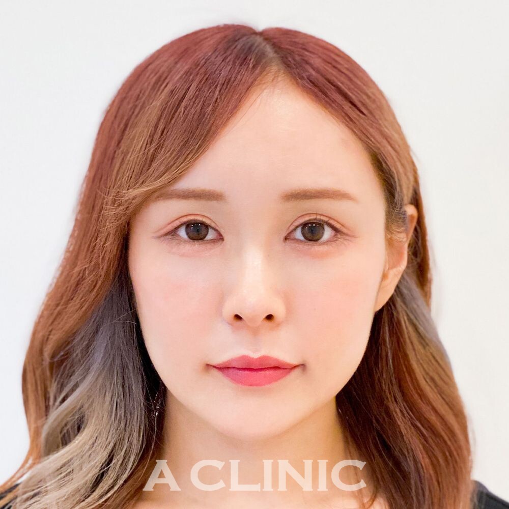 理想の小顔美人が叶うAスレッド！こちら処置前と処置直後の症例です(20代女性) BEFORE