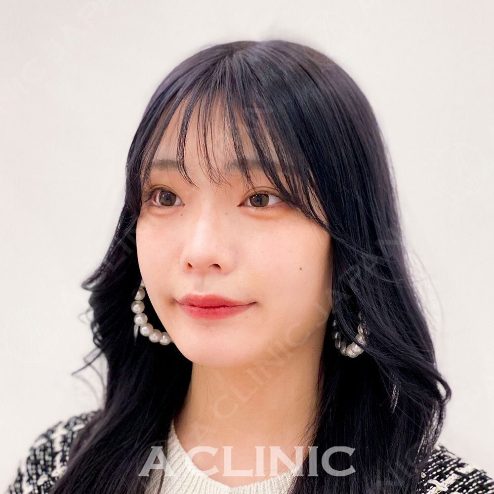 ダウンタイムや腫れがほぼない糸リフトと言えばAスレッド！処置前と処置直後の症例です(10代女性) BEFORE