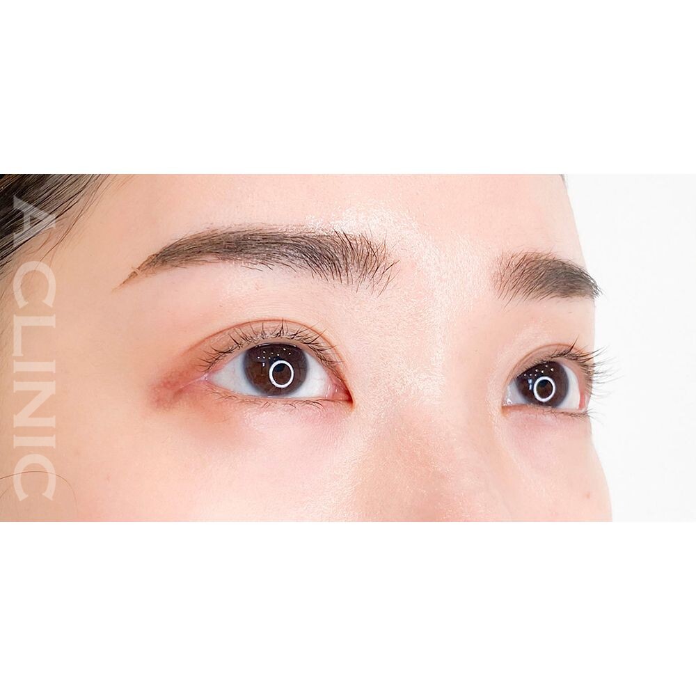 目が大きくなるとカラコンもまつエクも映えます！パーフェクトアイズの処置前と2週間後の症例です(20代女性) AFTER