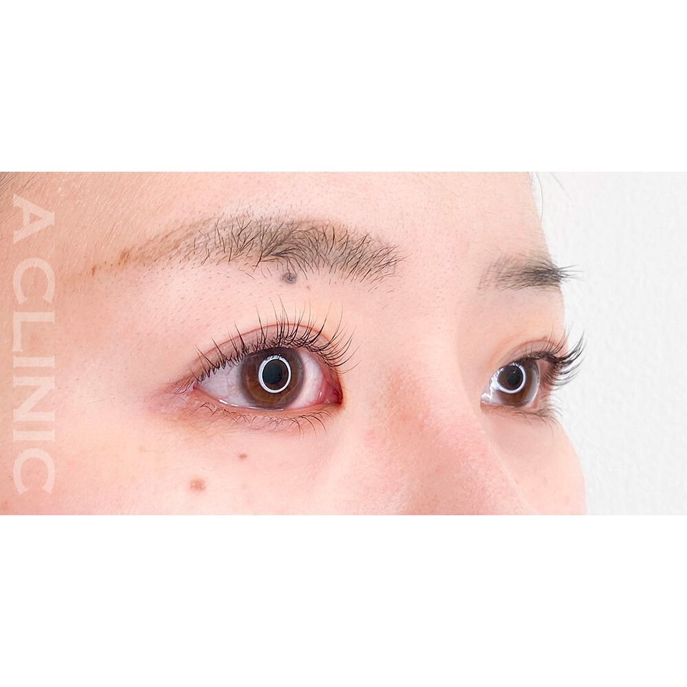 目の縦と横幅が広がりパッチリとした印象の瞳になります！パーフェクトアイズの処置前と2週間後の症例です(20代女性) AFTER