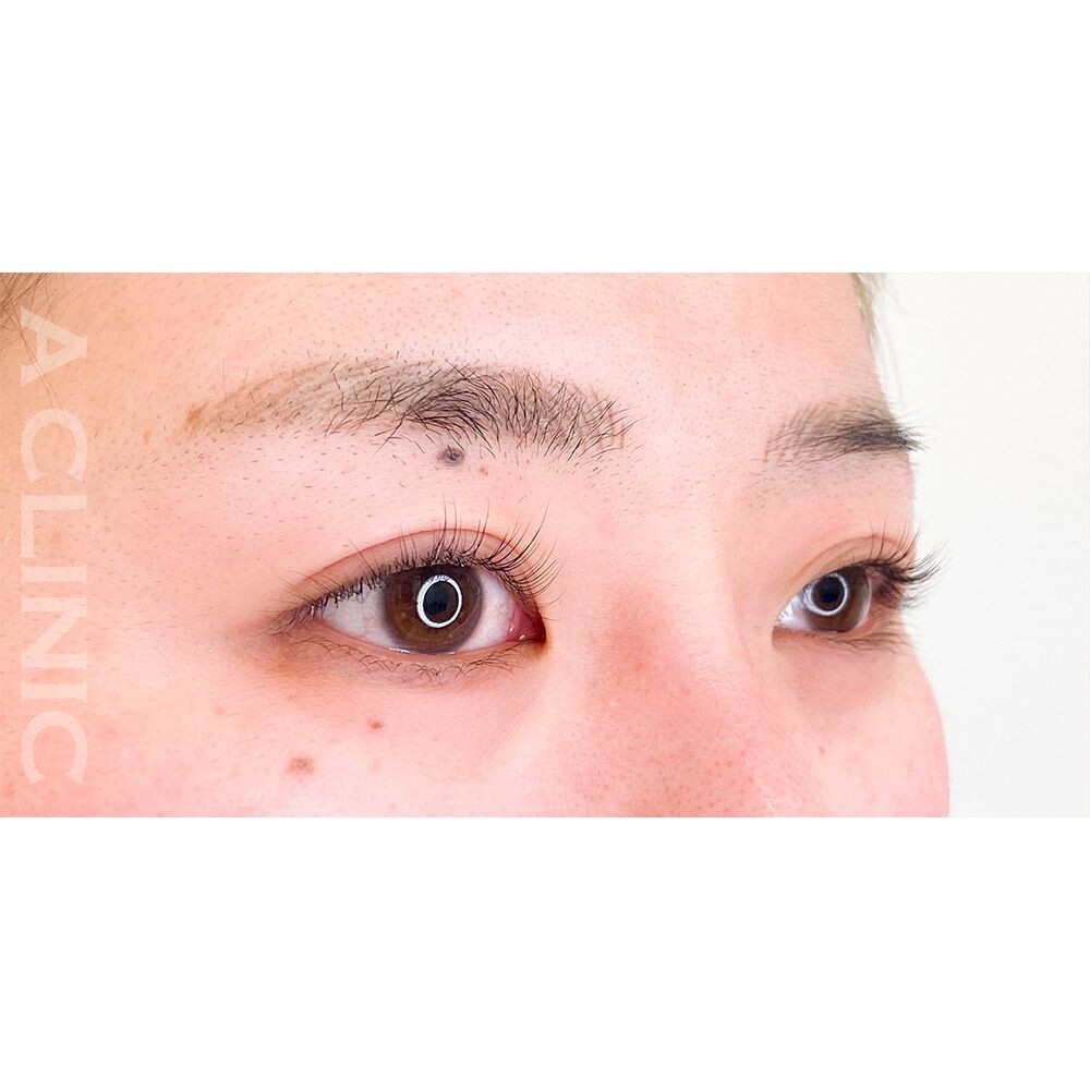 目の縦と横幅が広がりパッチリとした印象の瞳になります！パーフェクトアイズの処置前と2週間後の症例です(20代女性) BEFORE