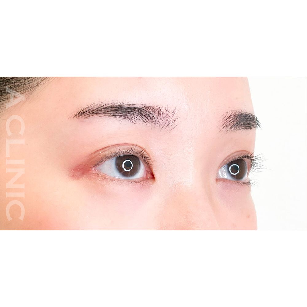 目が大きくなるとカラコンもまつエクも映えます！パーフェクトアイズの処置前と2週間後の症例です(20代女性) BEFORE