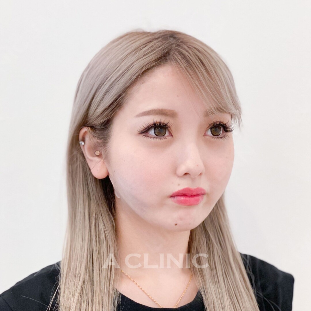 処置直後でも腫れが最小限で速攻小顔！1day小顔脂肪吸引の処置前と処置直後の症例です(20代女性) AFTER