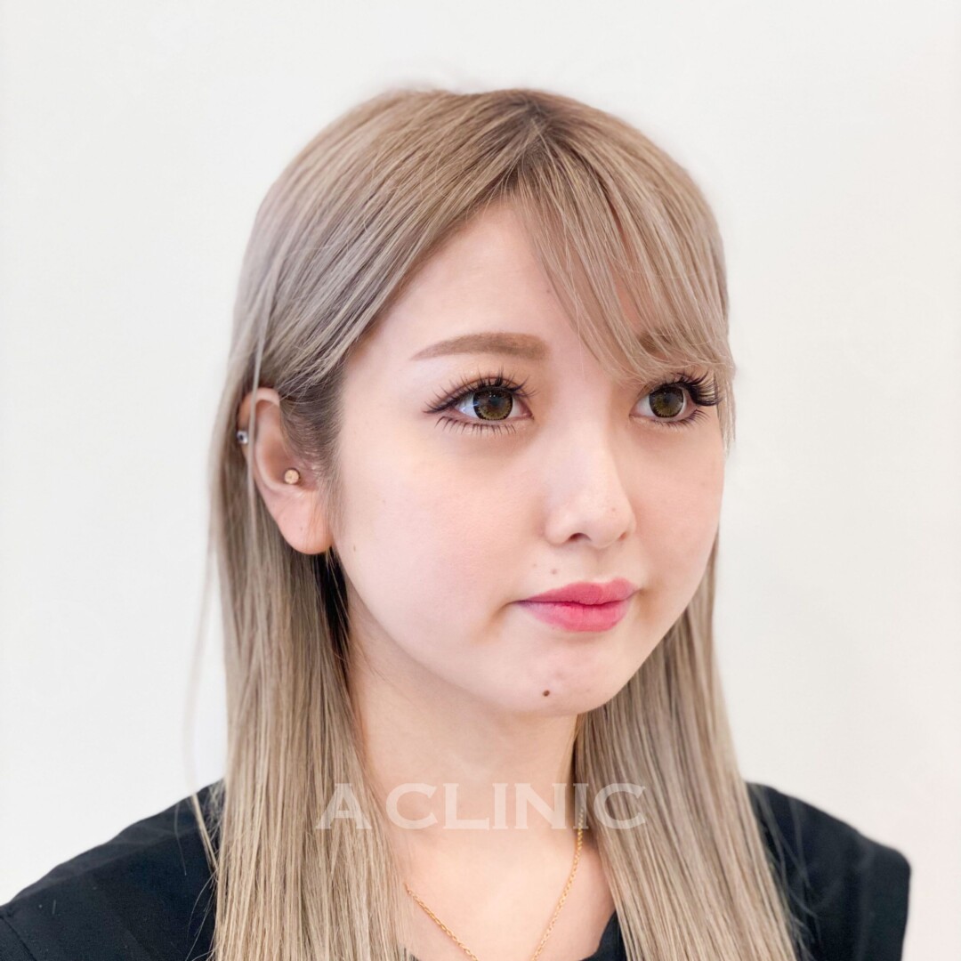 処置直後でも腫れが最小限で速攻小顔！1day小顔脂肪吸引の処置前と処置直後の症例です(20代女性) BEFORE