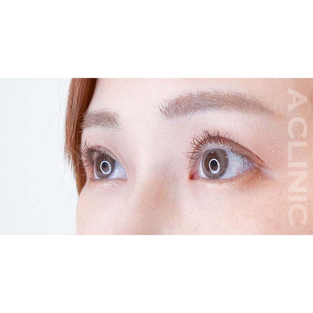 パーフェクトアイズで愛されたれ目に！処置前と2週間後の症例です(30代女性) AFTER