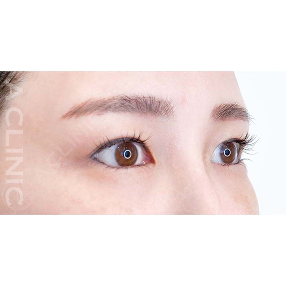 パーフェクトアイズは目元の縦幅を広げたい方にお勧めです！処置前と2週間後の症例です(40代女性) AFTER