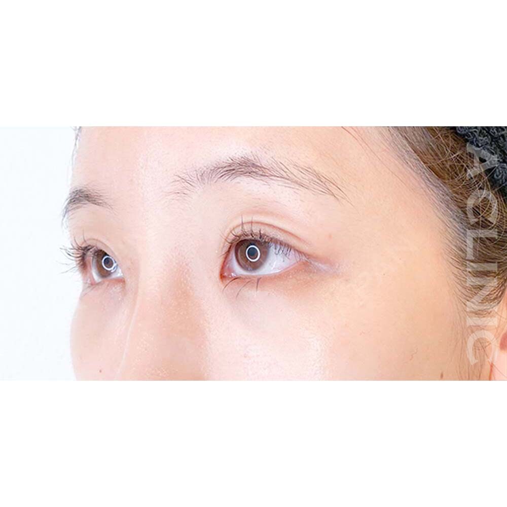 パーフェクトアイズでかわいい印象になりたいあなたへ！処置前と2週間後の症例です(20代女性) AFTER