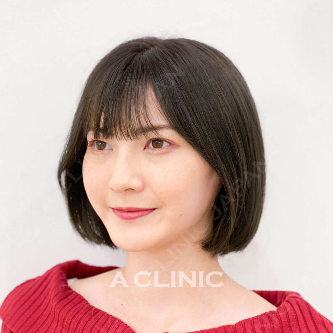 Aスレッドならリフトアップとアンチエイジングを同時にGET！処置前と処置直後の症例です(20代女性) AFTER