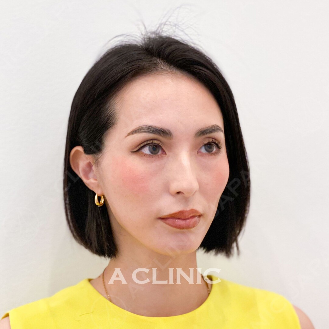 Aスレッドで小顔になり首も細長く見えます！ 処置前と処置直後の症例です(30代女性) AFTER