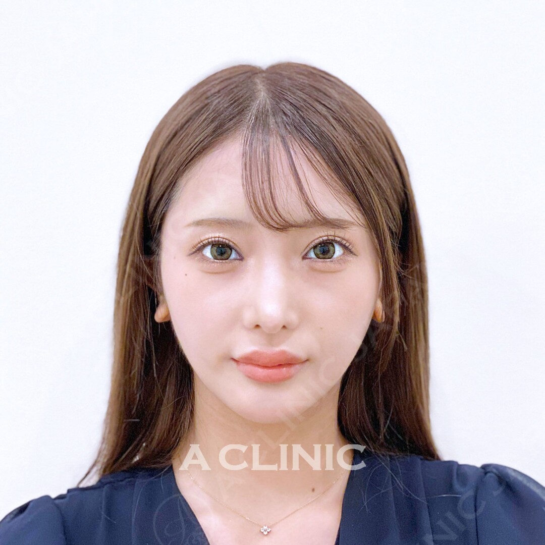 Aスレッドで憧れの小顔GETしませんか？処置前と処置直後の症例です(20代女性) AFTER