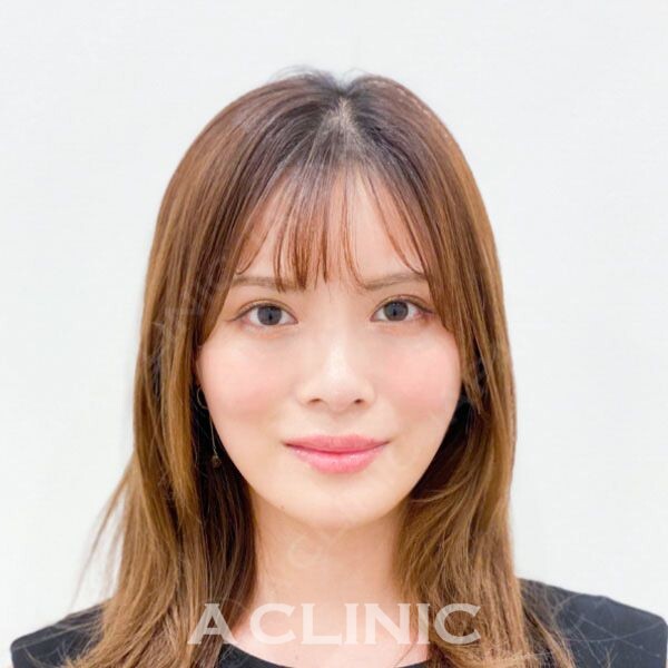 Aスレッドで即日小顔をGET！褒められる輪郭に！処置前と処置直後の症例です(20代女性) AFTER