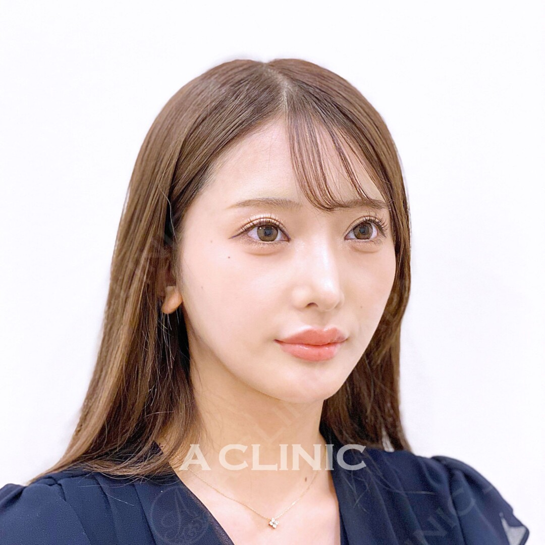 Aスレッドで切らずに即日小顔！ 処置前と処置直後の症例です(20代女性) AFTER