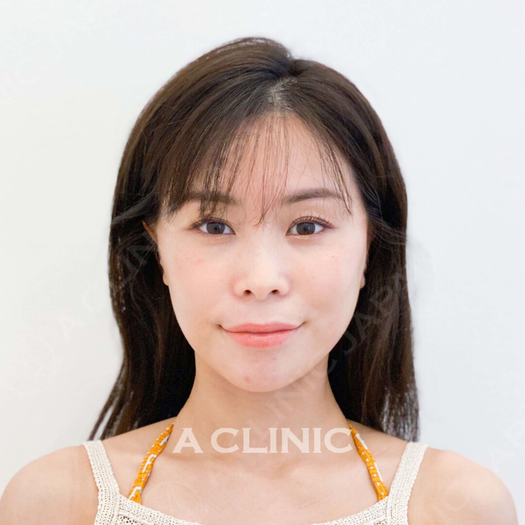 Aスレッドでほほのもたつきも即日解消！処置前と処置直後の症例です(30代女性) AFTER