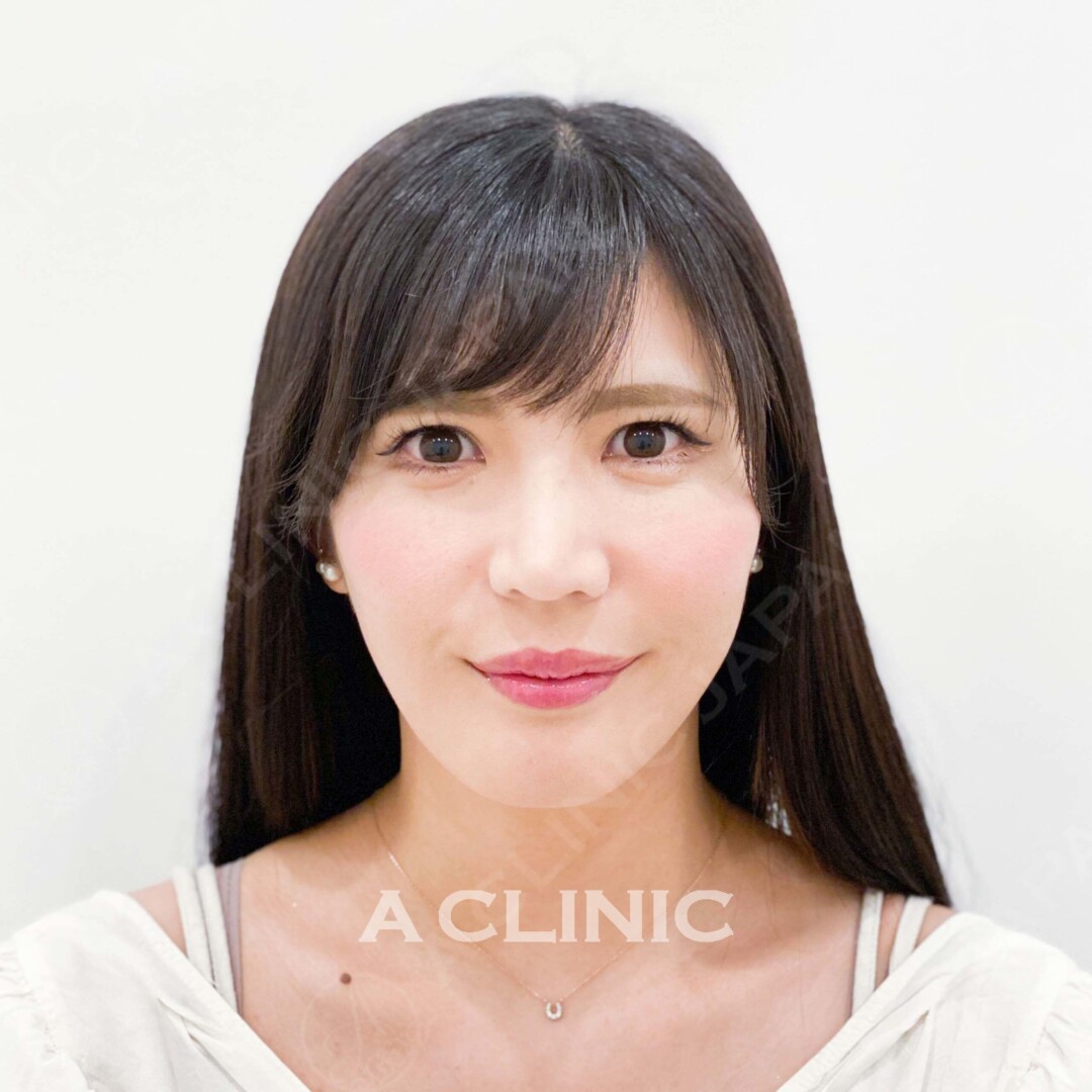 理想のVフェイスを即日ゲット！Aスレッドの処置前と処置直後の症例です(30代女性) AFTER