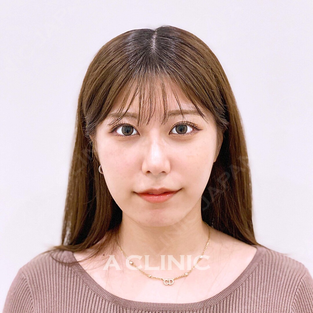 Aスレッドはたるみの改善もしたるみの予防にも効果があります！処置前と処置直後の症例です(20代女性) AFTER