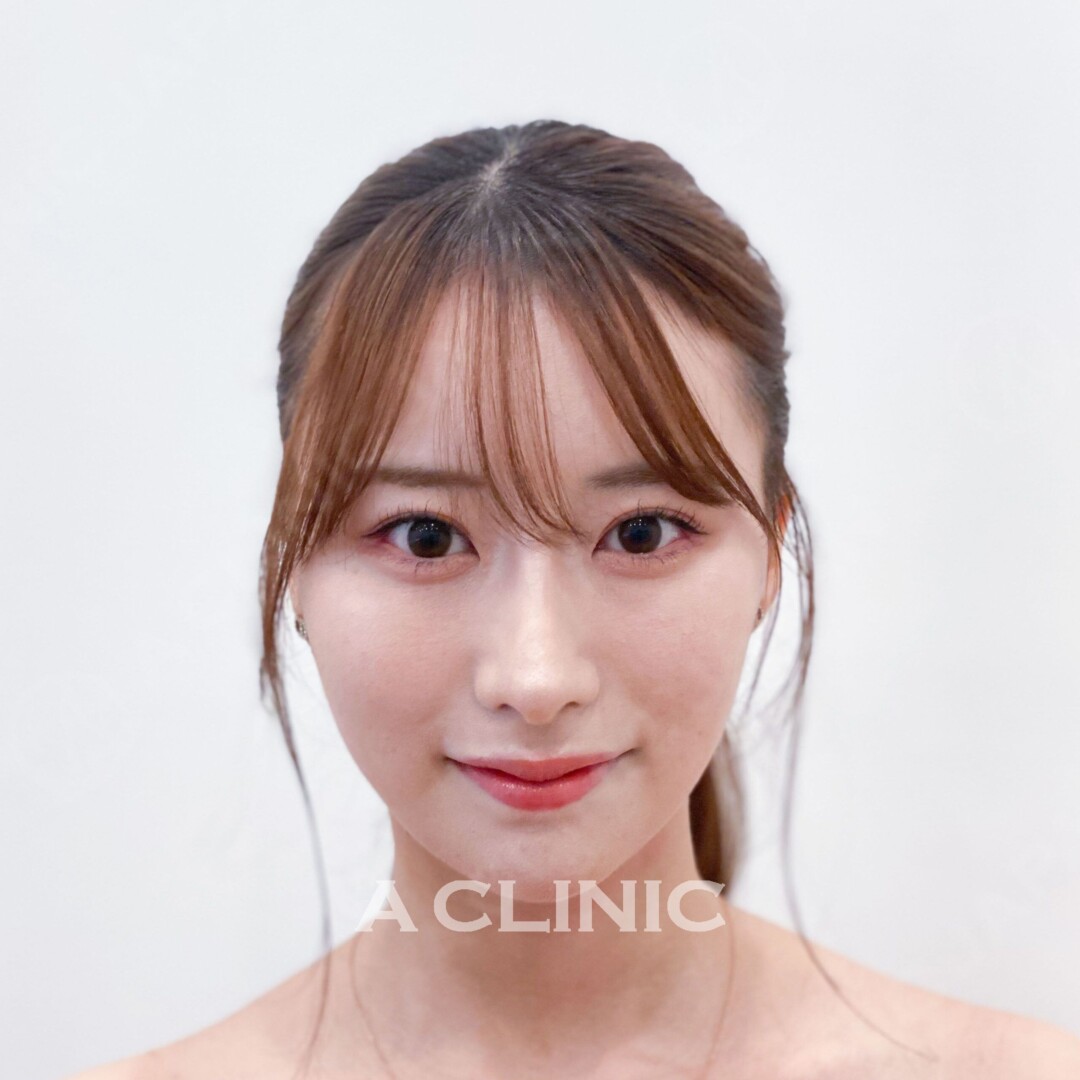 Aスレッドなら理想のVラインフェイスになれます！処置前と処置直後の症例です(20代女性) AFTER