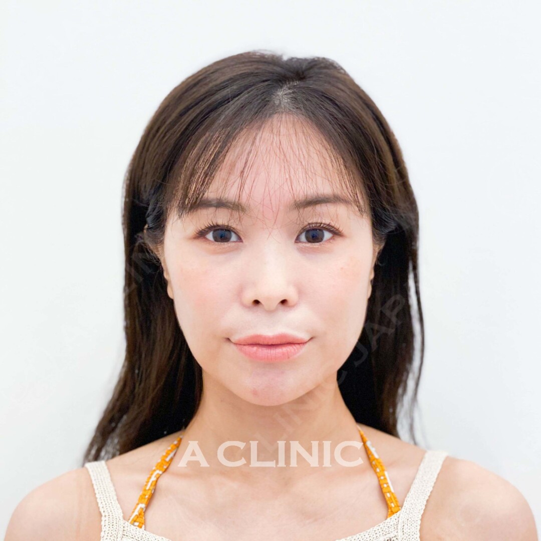 Aスレッドでほほのもたつきも即日解消！処置前と処置直後の症例です(30代女性) BEFORE