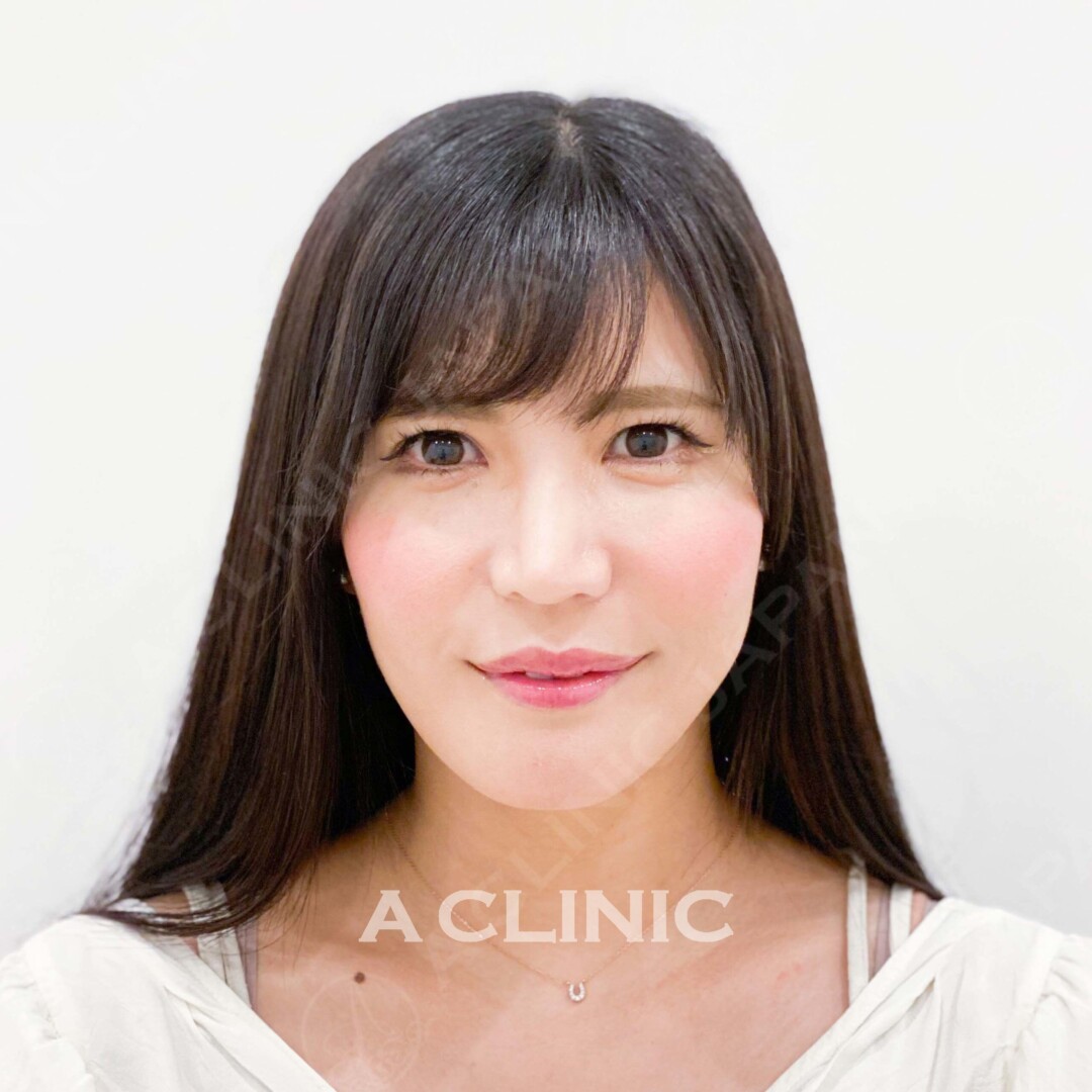 理想のVフェイスを即日ゲット！Aスレッドの処置前と処置直後の症例です(30代女性) BEFORE