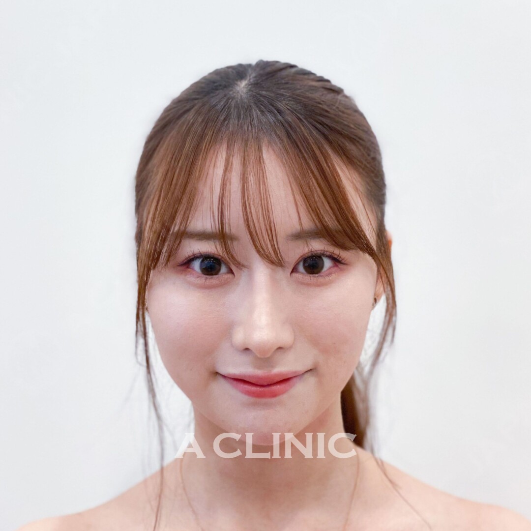 Aスレッドなら理想のVラインフェイスになれます！処置前と処置直後の症例です(20代女性) BEFORE
