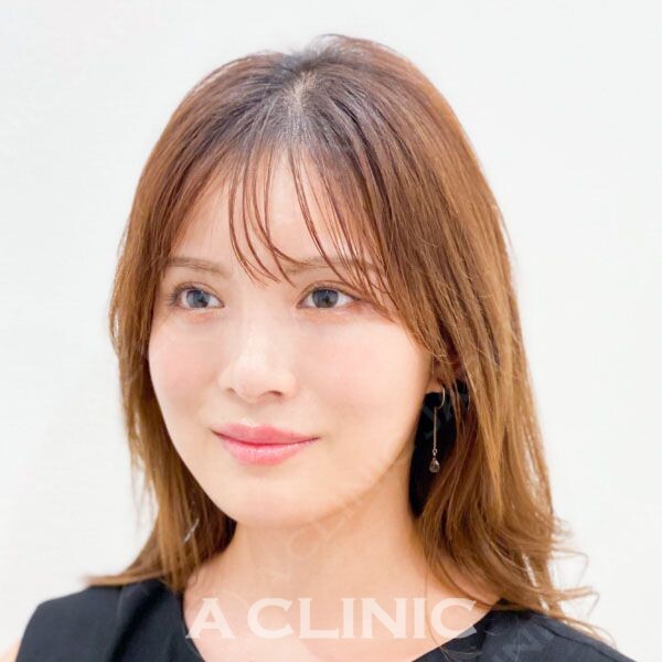 小顔といえばAスレッド！15分でこの変化！処置前と処置直後の症例です(20代女性) BEFORE