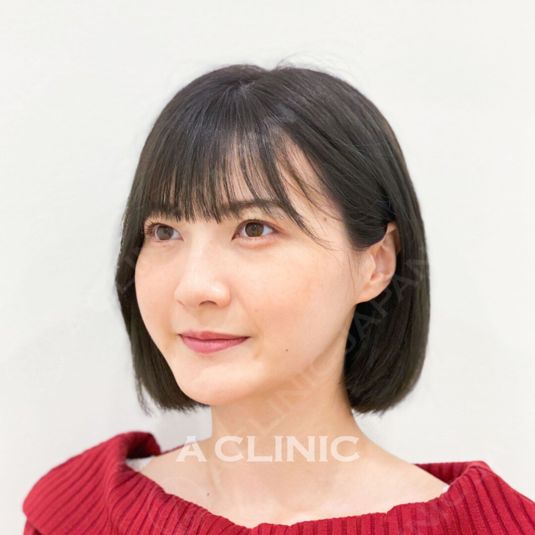 Aスレッドならリフトアップとアンチエイジングを同時にGET！処置前と処置直後の症例です(20代女性) BEFORE