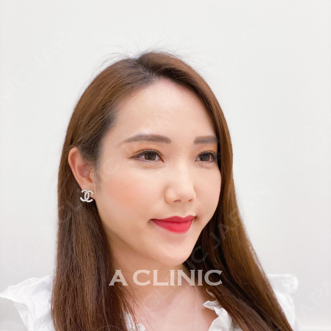 Aスレッドでエラ周りもすっきりリフトアップ！処置前と処置直後の症例です(30代女性) BEFORE