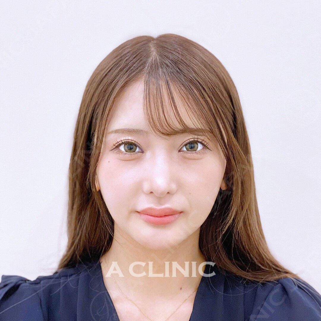 Aスレッドで憧れの小顔GETしませんか？処置前と処置直後の症例です(20代女性) BEFORE