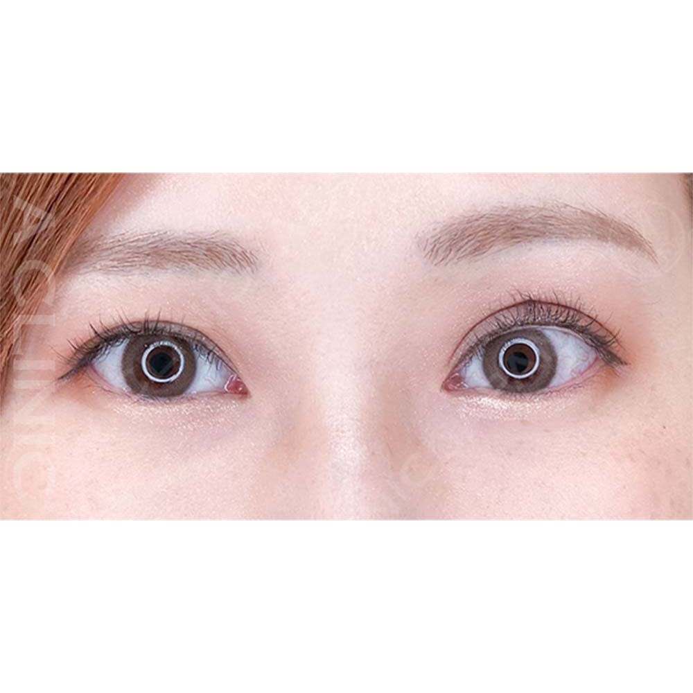 パーフェクトアイズで自然に大きい目元になりました！処置前と2週間後の症例です(30代女性) BEFORE