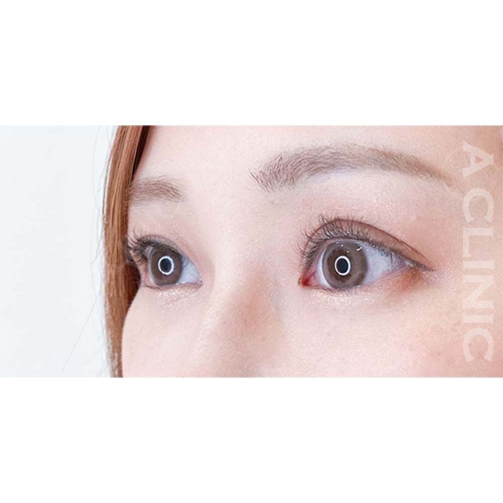 パーフェクトアイズで愛されたれ目に！処置前と2週間後の症例です(30代女性) BEFORE