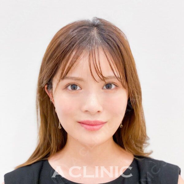 Aスレッドで即日小顔をGET！褒められる輪郭に！処置前と処置直後の症例です(20代女性) BEFORE