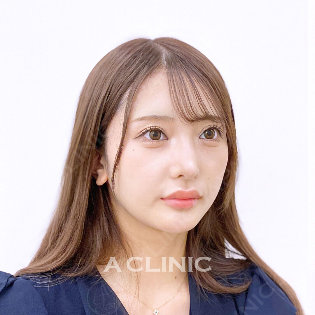 Aスレッドで切らずに即日小顔！ 処置前と処置直後の症例です(20代女性) BEFORE