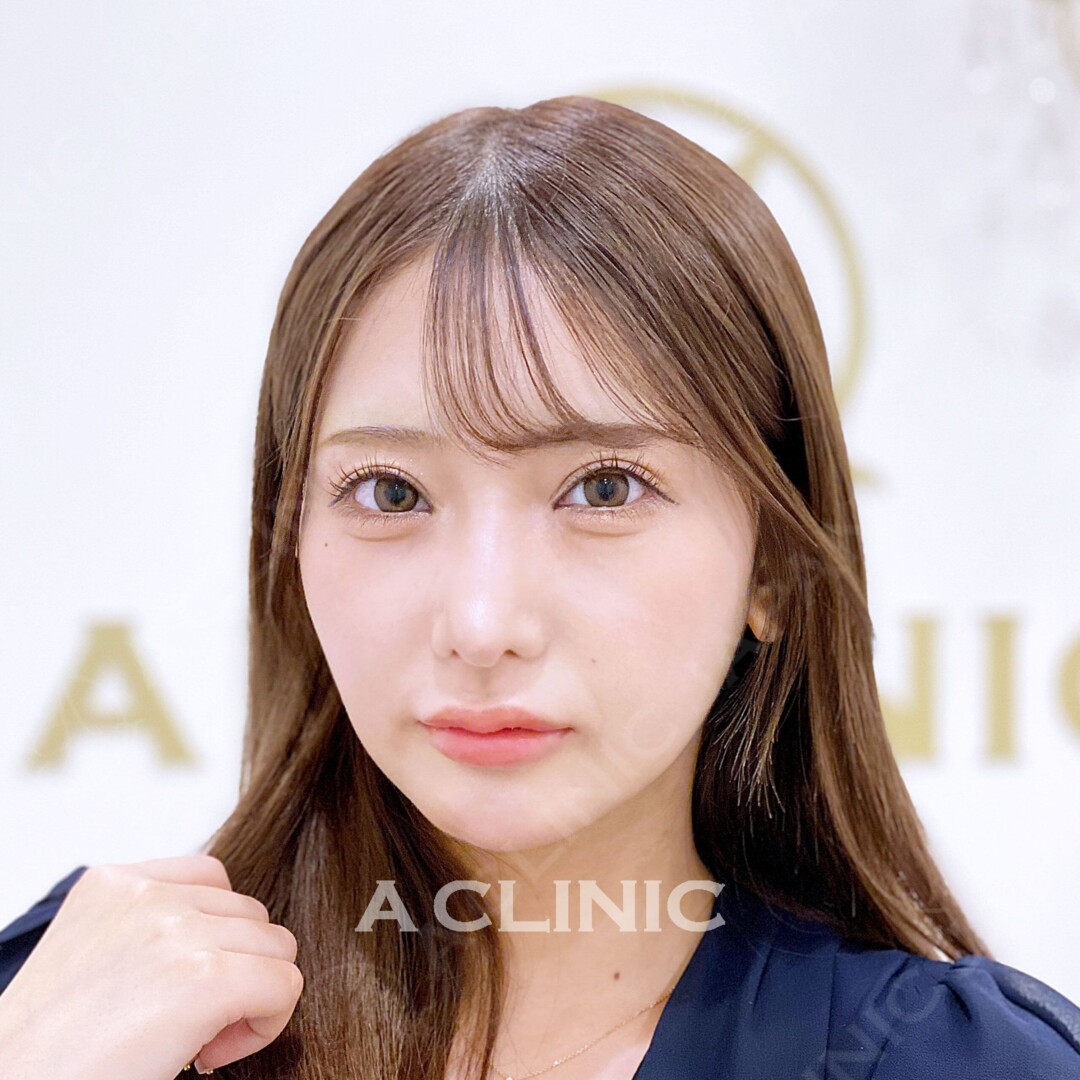 Aスレッドで綺麗なVフェイスに変化！処置前と処置直後の症例です(20代女性) BEFORE
