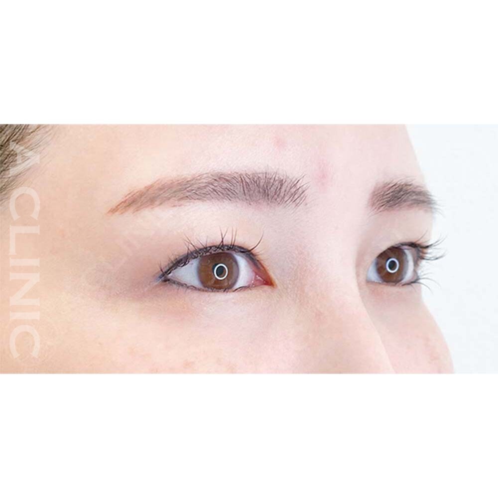 パーフェクトアイズは目元の縦幅を広げたい方にお勧めです！処置前と2週間後の症例です(40代女性) BEFORE