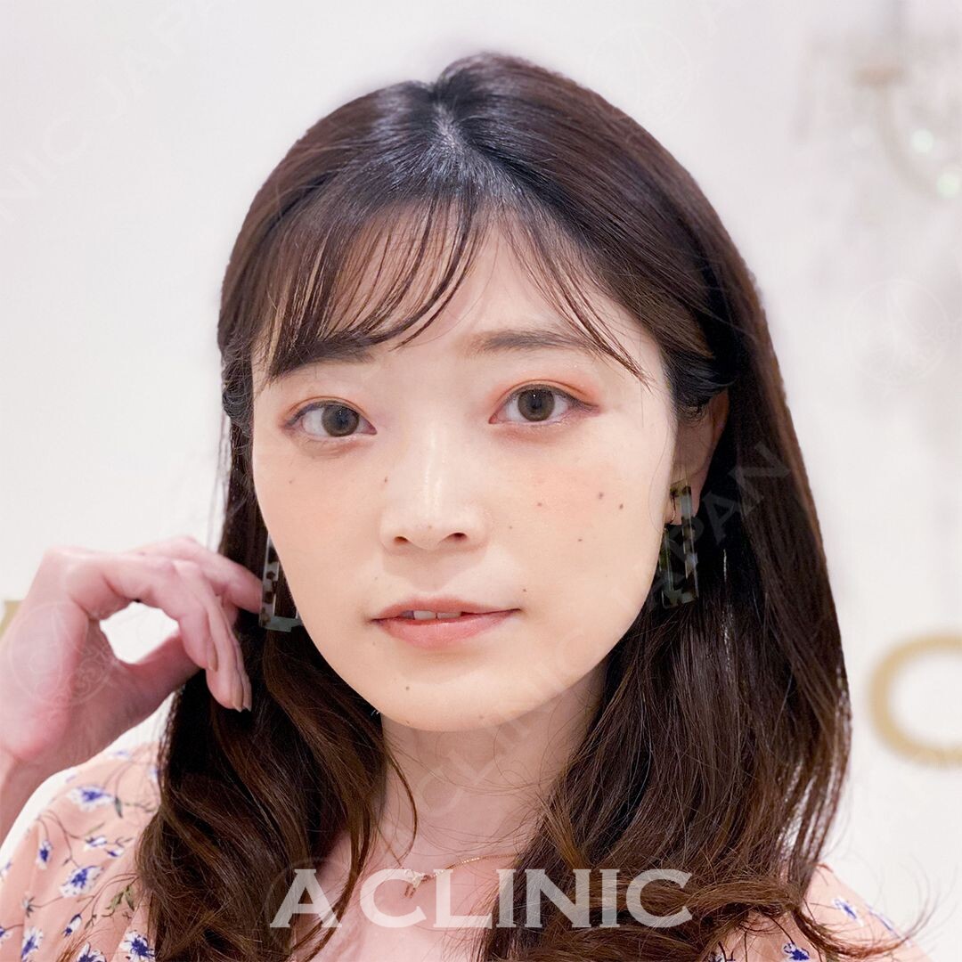 小顔美人になりたい方必見です！Aスレッドで直後から洗練された小顔に(30代女性) AFTER