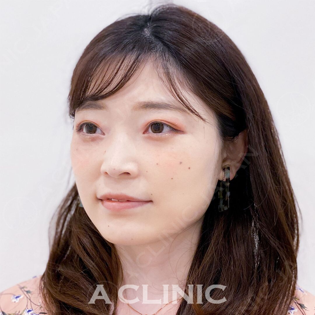 Aスレッドでフェイスラインのもたつきを即解消！処置直後からこんなにスッキリします(30代女性) AFTER