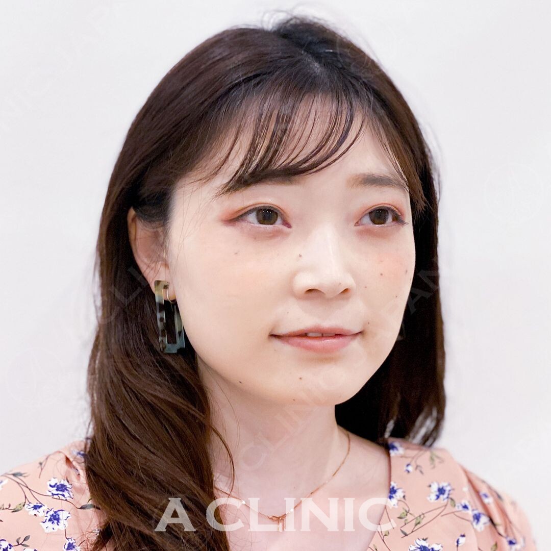 フェイスラインのもたつきを15分で解消！即日小顔になれるAスレッドの直後の症例です(30代女性) AFTER