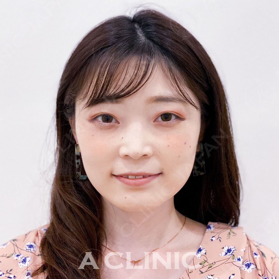 左右差を解消してスッキリ小顔に！Aスレッドの処置直後の症例写真です(30代女性) AFTER