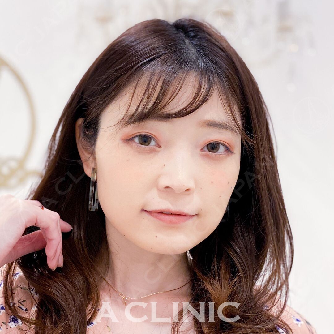 小顔美人になりたい方必見です！Aスレッドで直後から洗練された小顔に(30代女性) BEFORE