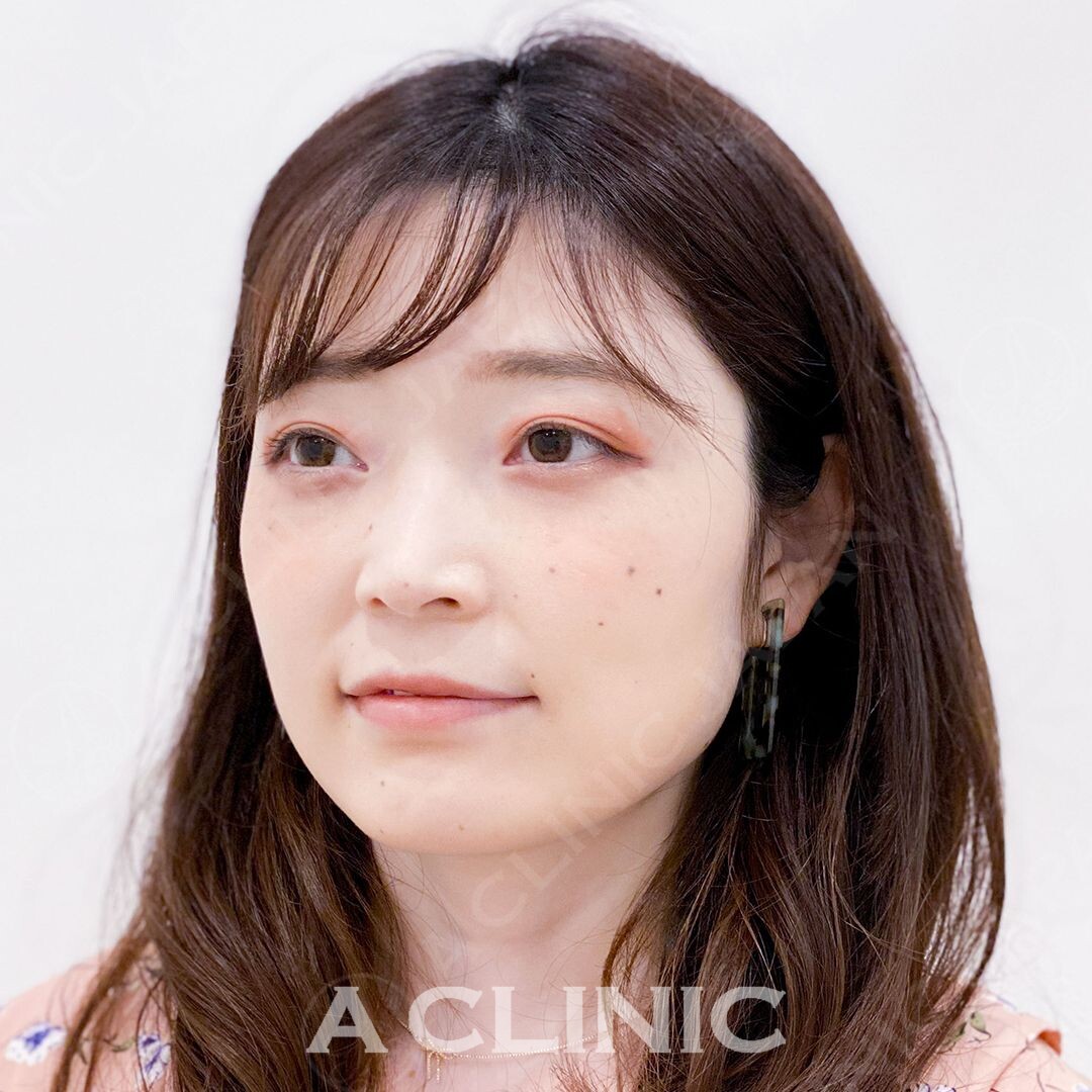 Aスレッドでフェイスラインのもたつきを即解消！処置直後からこんなにスッキリします(30代女性) BEFORE