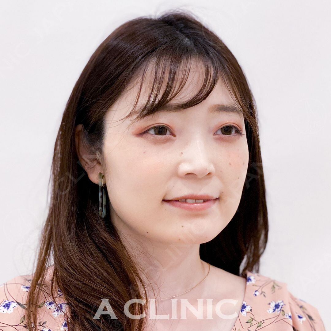 フェイスラインのもたつきを15分で解消！即日小顔になれるAスレッドの直後の症例です(30代女性) BEFORE