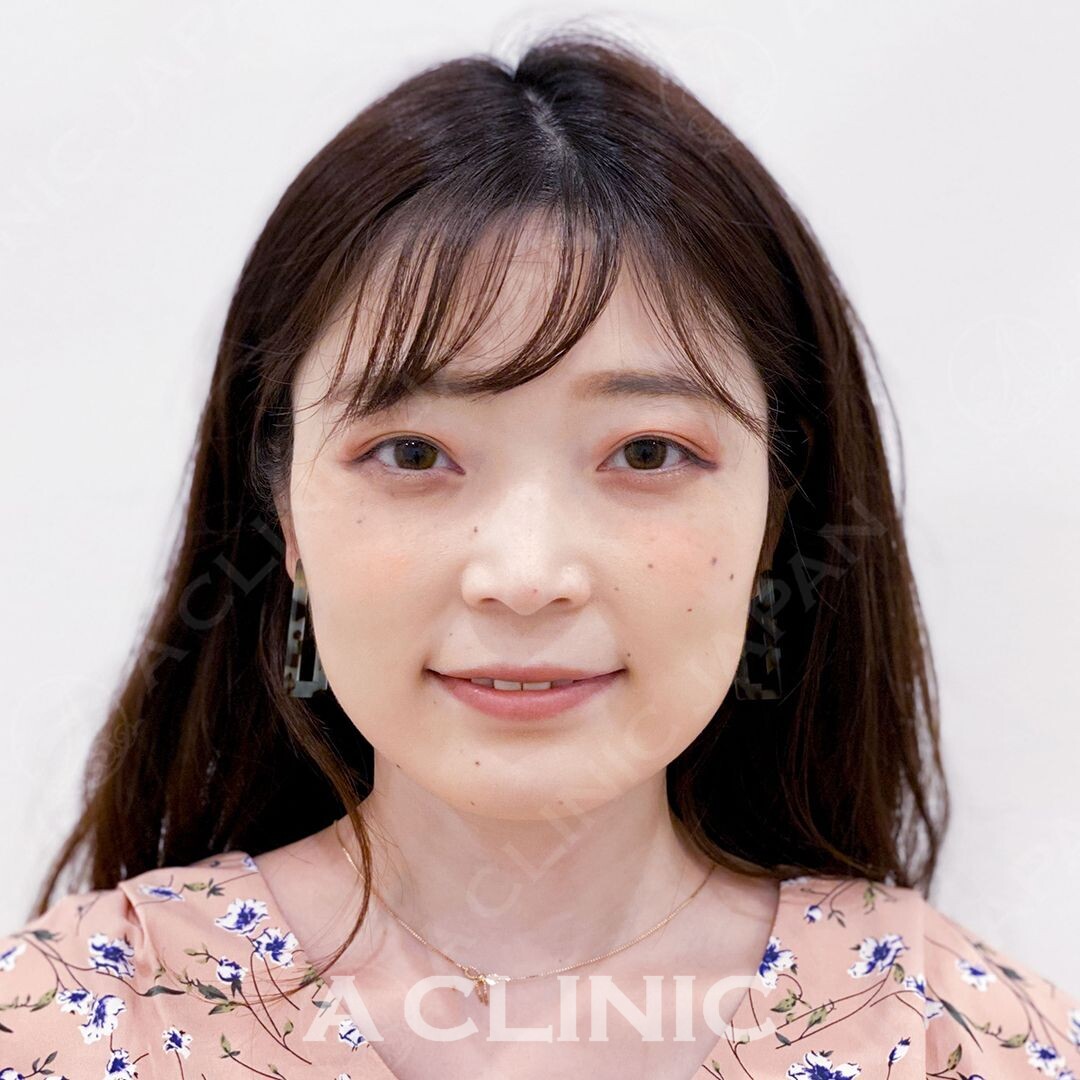 左右差を解消してスッキリ小顔に！Aスレッドの処置直後の症例写真です(30代女性) BEFORE