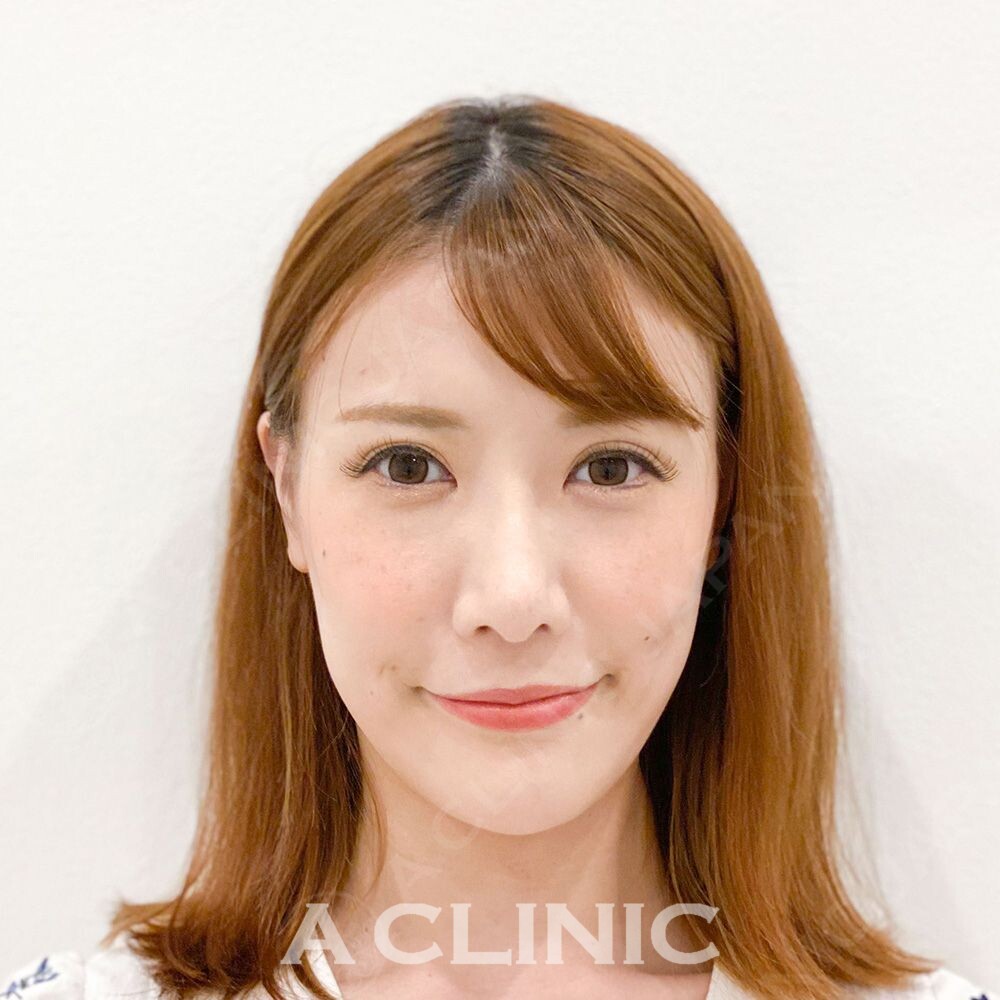 Aスレッドでフェイスラインのもたつきを改善するだけで若返った印象に！処置前と処置直後の症例です(30代女性) AFTER