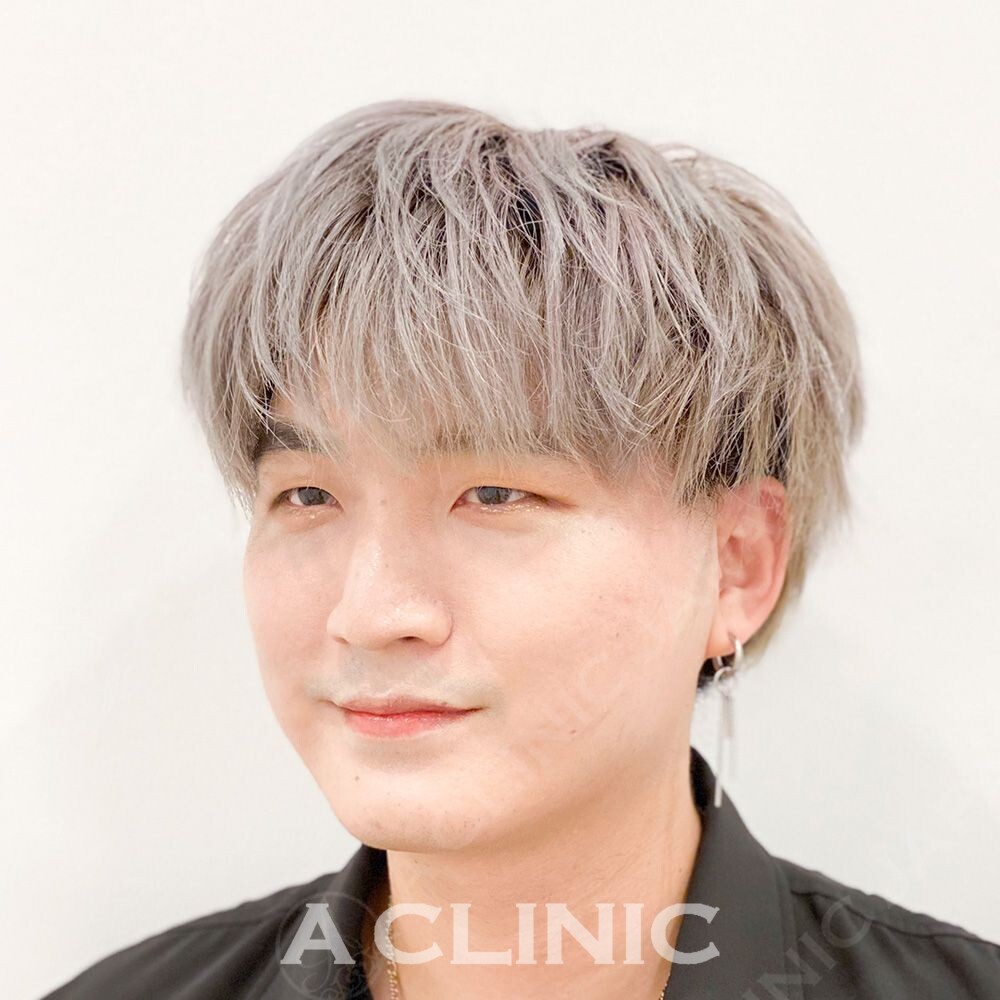 Aスレッドで瞬時に肌が引き上がる！将来的なたるみ予防にも！処置前と処置直後の症例です(30代男性) AFTER