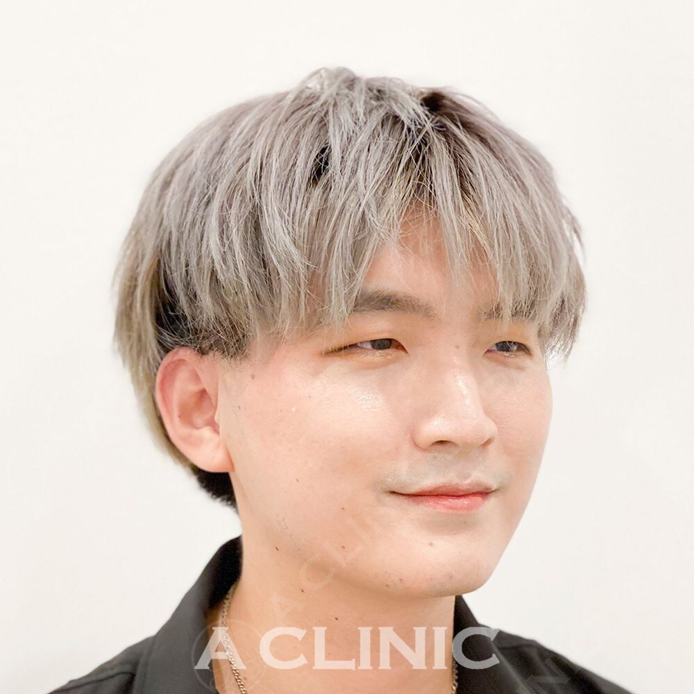 Aスレッドで15分で見た目が自然に若返ります！処置前と処置直後の症例です(30代男性) AFTER