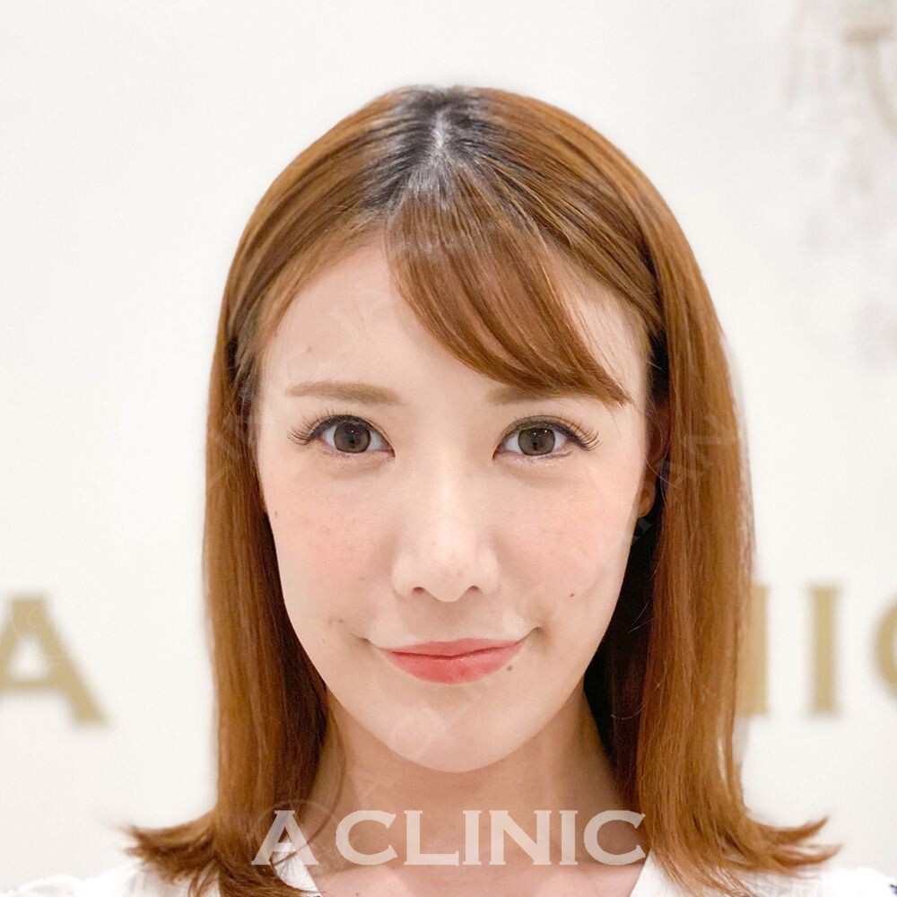 Aスレッドはたった15分でフェイスラインのたるみをしっかり引き上げます！処置前と処置直後の症例です(30代女性) AFTER