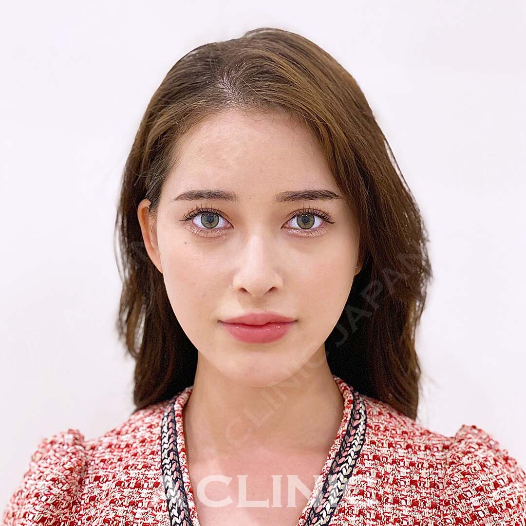 元々小顔の方でもしっかり引き上げ小顔に仕上がります！Aスレッドの処置前と処置直後の症例です(20代女性) AFTER