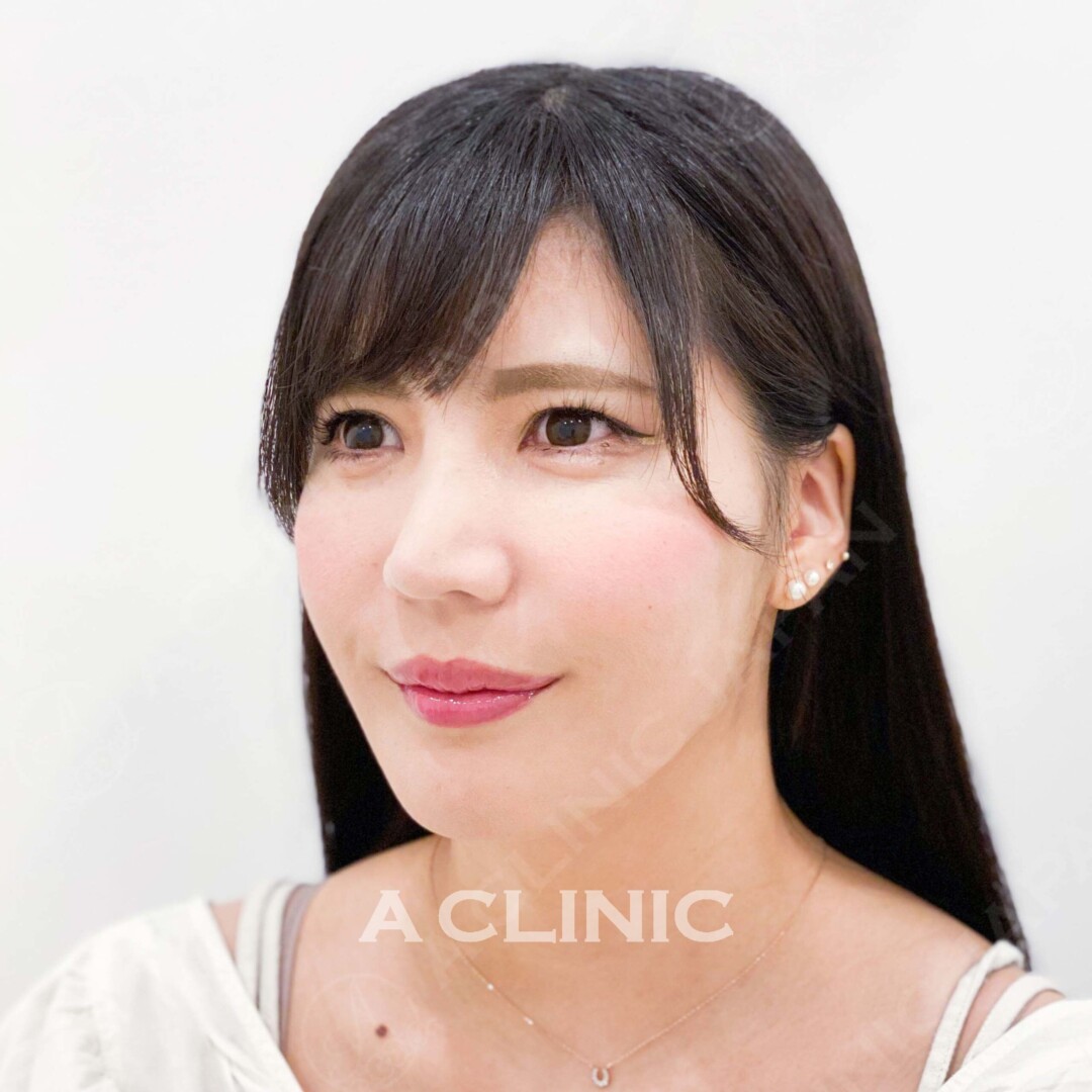 頬のたるみもナチュラルにすっきり除去！Aスレッドの処置前と処置直後の症例です(30代女性) AFTER