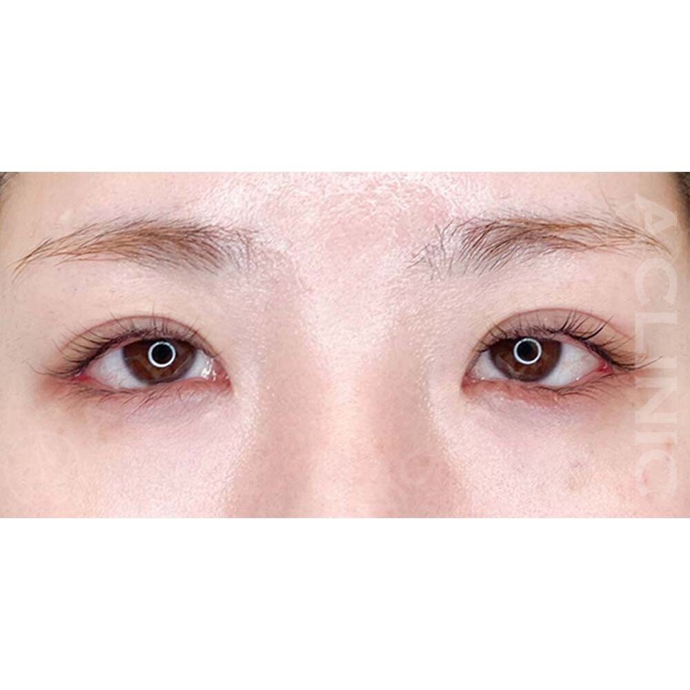 つり目が柔らかい印象に変わりました！パーフェクトアイズの処置前と2週間後の症例です(30代女性) AFTER