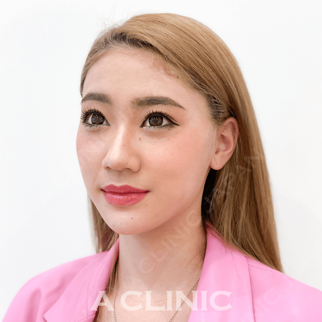 直後から綺麗な横顔に！Aスレッド処置前と処置直後の症例です(20代女性) AFTER